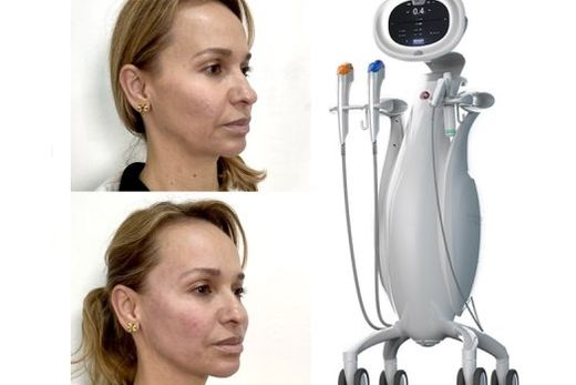 Efeito lifting sem cirurgia. Foto do antes e depois da aplicação do Ultraformer MPT no rosto todo mostra resultado imediato