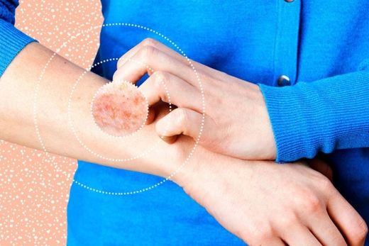 Psoríase: dermatose de causas desconhecidas