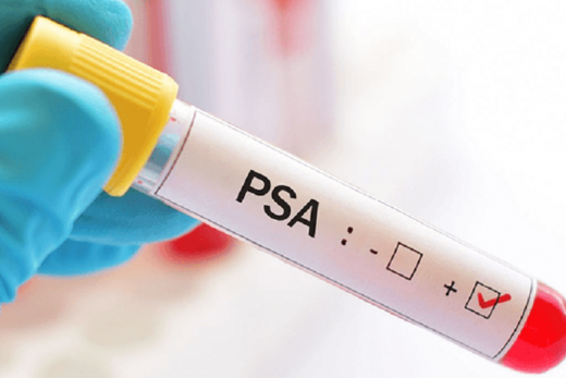O que é o exame de PSA para câncer de próstata